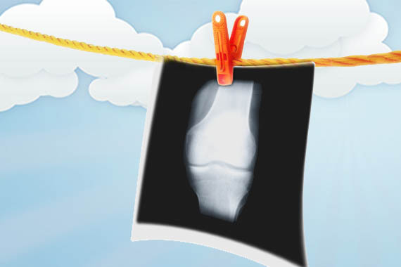 Akutne poškodbe kolena