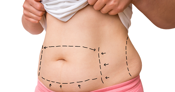 abdominoplastika