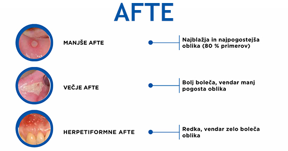 Afte v ustih: pogosta težava in učinkovite rešitve.