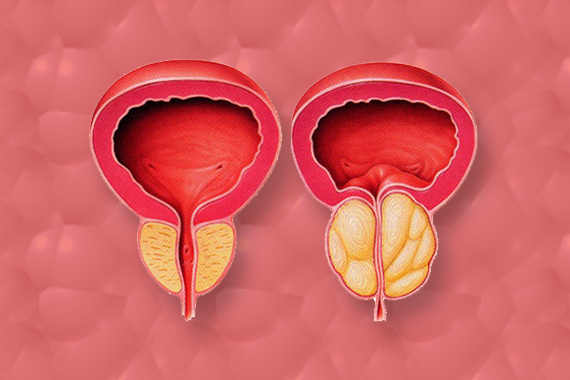 Prostata - majhna žleza in velike težave - Slika 1